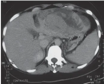 Figure 2. Unenhanced abdominal computed tomography, demonstrating the presence of hypo and hyperdense areas affecting the left hepatic lobe.
