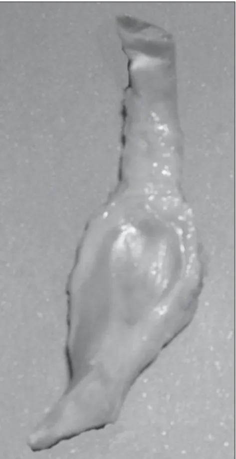 Figure 1. Tendinous segment of the peroneus lon- lon-gus muscle. Macroscopic analysis of the tendon demonstrating spindle-shaped widening in the area adjacent to the cuboid bone