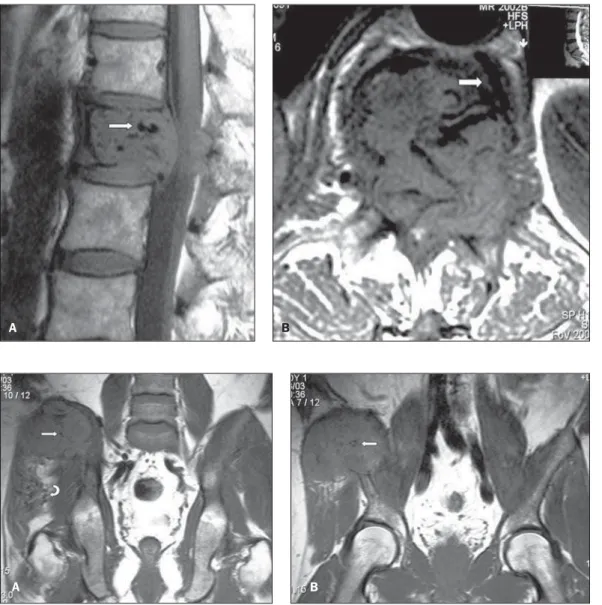 Figure 1. A: Sagittal MRI T1- T1-weighted images of the  lum-bar spine of a male,  69-year-old patient demonstrating hypointense lesion at L1, with tubular images suggesting the presence of vessels (arrow)