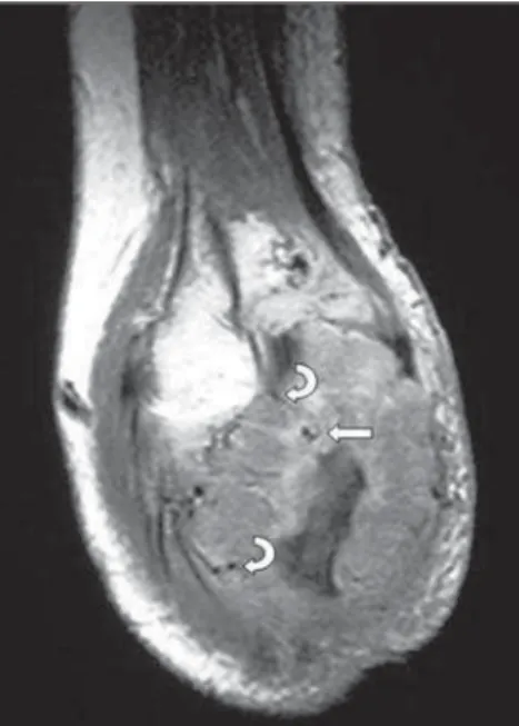 Figure 3. Paramagnetic contrast-enhanced MRI coronal image of elbow demonstrating  hyper-vascularization within (straight arrow) and in the periphery of the lesion (curved arrows).