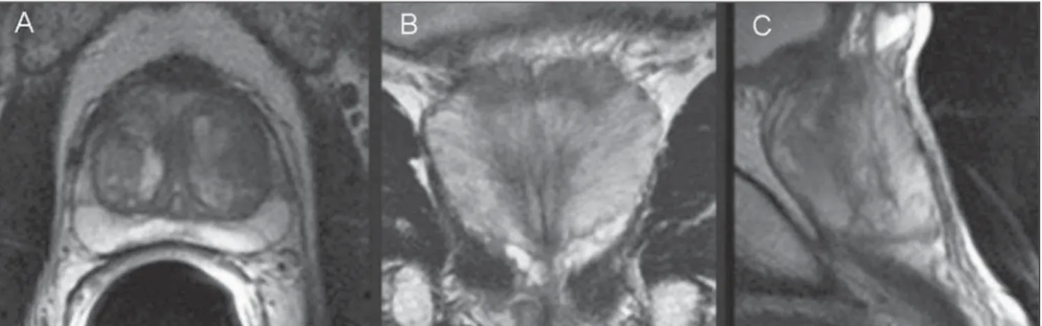 Figure 2. Endorectal coil MR, high-resolution T2-weighted images – axial (A), coronal (B), and sagittal (C) planes.