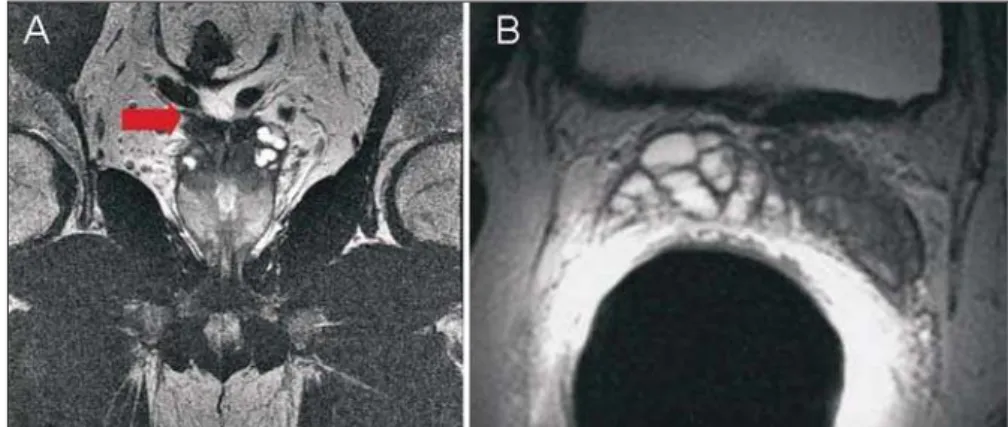 Figure 3. Endorectal coil MR – axial T2-weighted images depicting examples of nodular (A) and poorly defined (B) PCa.