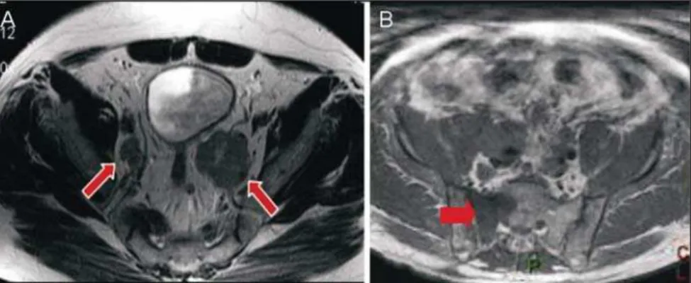 Figure 6. A: MR axial T2-weighted image demonstrating bilateral obturatory lymphadenopathy