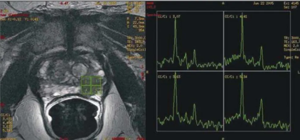 Figure 9. Paramagnetic contrast-enhanced MR axial T1-weighted image demonstrating a lesion with early enhancement in the right peripheral zone