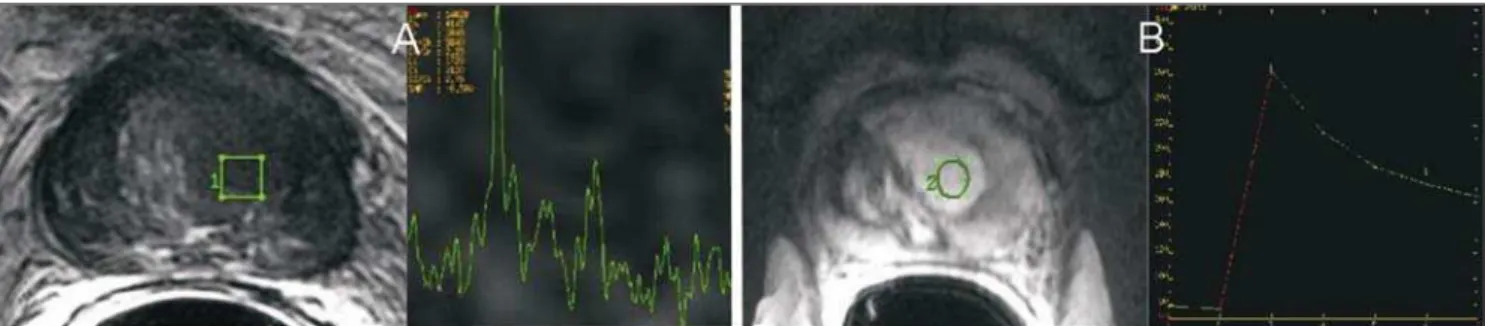 Figure 10. MR axial T2-weighted image demonstrating an ill-defined lesion markedly hypointense signal in the central gland at left, with elevated choline peak spectroscopy (A)
