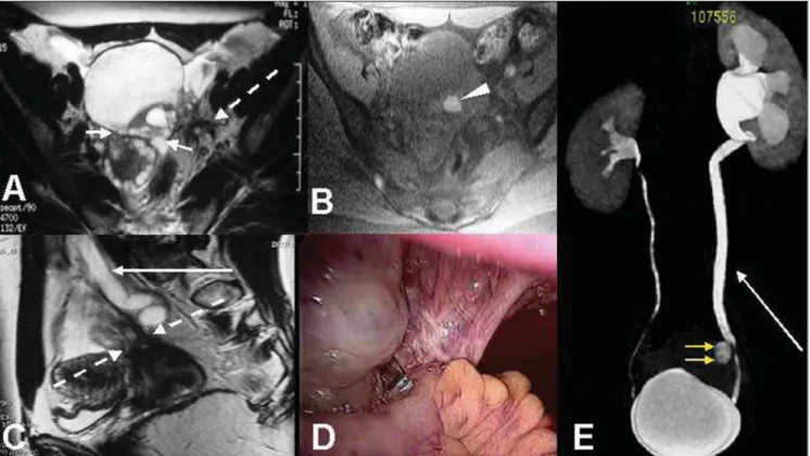 Figure 3. Axial (A) and sagittal (C) T2-weighted images, and axial, T1-weighted (B) image with fat suppression demonstrating a pelvic adhesion process with ovaries medialization without a defined cleavage plane between them, as well as with the vesical dom