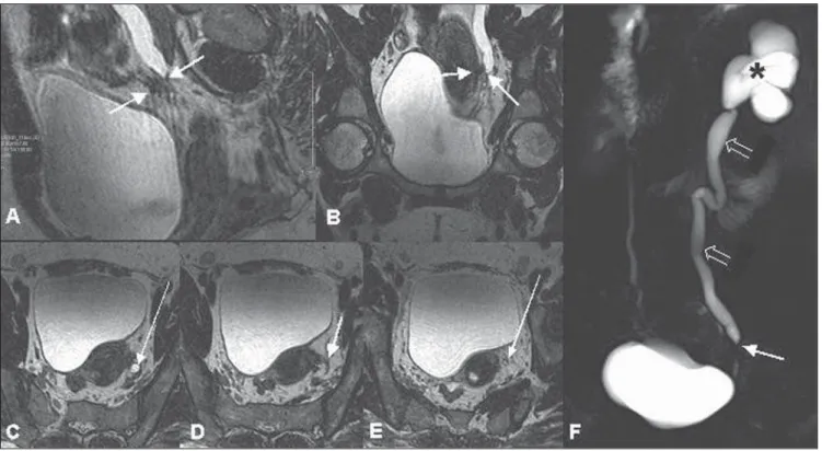 Figure 4. Sagittal (A), coronal (B) and axial (C,D,E) T2-weighted images and uro-resonance image (F) showing distal ureteral stenosis, related to an irregular, ill-defined, hypointense image on T2-weighted sequence, involving the left pelvic ureter (short 