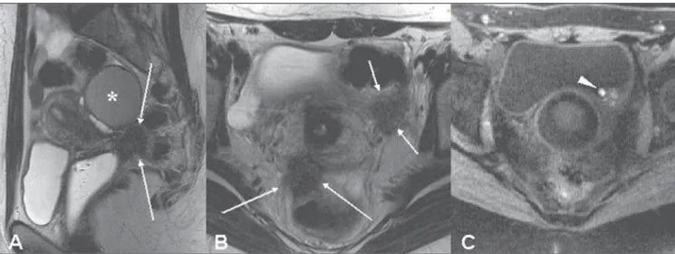 Figure 6. Sagittal (A), axial (B) T2-weighted images; and axial T1-weighted image with fat suppression (C) showing focal, hypointense thickening on T2-weighted sequence of the left postero-lateral bladder wall (short arrows), with minimum intermingled blee