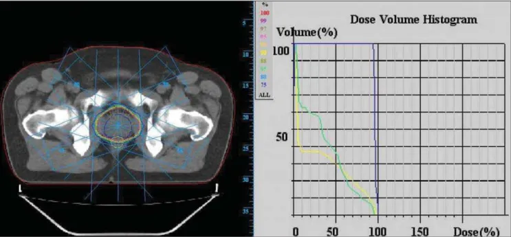 Figure 1. Axial CT view for 3DCRT planning for prostate cancer with respective dose-volume histogram showing the dose rate in prostate (blue), bladder (green) and rectum (yellow).