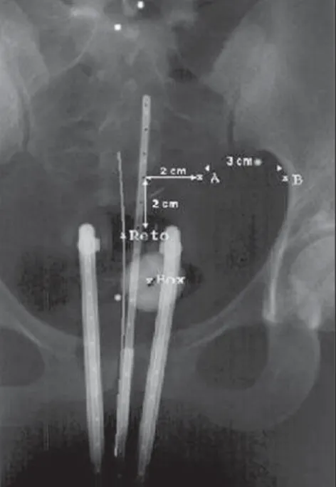 Figure 1. Points A (prescription) and B, and iden- iden-tification of the rectum and bladder of a patient to be submitted to HDR brachytherapy for uterine cervix cancer.