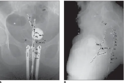 Figure 3. Anteroposterior and lateral radiographic images of a patient to be submitted to HDR brachytherapy or uterine cervix cancer, showing the gynecologic applicator and the rectal probe containing radiopaque wires.