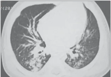 Table 3 Chest computed tomography findings in the patients evaluated by the present study.