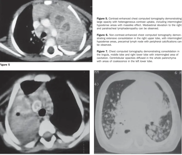 Figure 5. Contrast-enhanced chest computed tomography demonstrating large opacity with heterogeneous contrast uptake, including intermingled hypodense areas with masslike effect