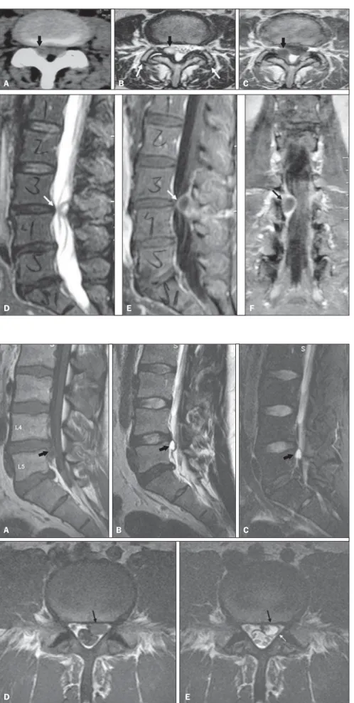 Figure 5. Synovial cyst. Female, 65-year-old patient with right-sided sciatic pain. CT (A) demonstrates hypodense mass (black arrow) adjacent to the right interapophyseal joint at the L3/L4 level