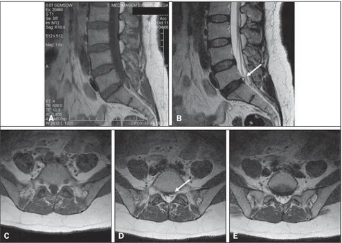 Figure 7. Discal cyst. Female, 42-year-old patient with left-sided lumbar sciatic pain