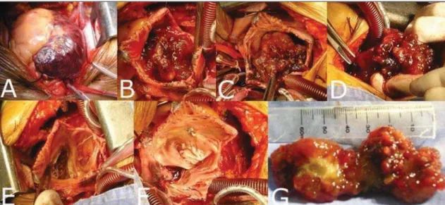 Figura 4. Etapas da ressecção cirúrgica. A: Pericardiotomia com demonstração das cavidades direitas aumentadas de tamanho