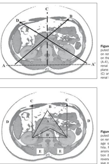 Figure 1. Abdominal com- com-puted tomography, axial slice on renal hila. Imaginary plane on the spinal erector muscles (A-A’), inclination of the right renal hilum (B), reference plane of renal hila angulation (C) and inclination of the left renal hilum (