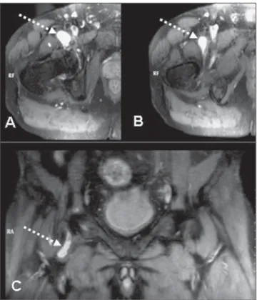 Figure 4. Intra-articular snapping hip. Magnetic resonance imaging demon- demon-strates loose intra-articular body (arrows) on coronal (A) and axial (B)  fluid-sensitive sequences with fat-saturation.