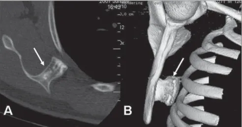 Figure 6. Patient with snapping in the dorsal region. A: Right scapular osteochondroma seen on axial computed tomography (arrow)