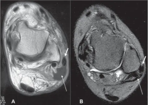 Figure 10. A: The arrows indicate the extensor carpi ulnaris tendon on an axial sonographic image with the forearm in pronation