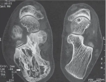 Figure 1. Computed to- to-mography of the  calca-neus, coronal section.  In-creased bone volume is observed, with gross and thickened trabeculae  (ar-row).