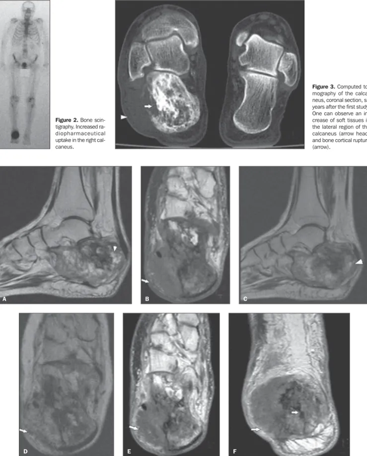 Figure 3. Computed to- to-mography of the  calca-neus, coronal section, six years after the first study.