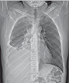 Figure 4. Chest CT, medias- medias-tinal window,  non-enhanced (A) and 