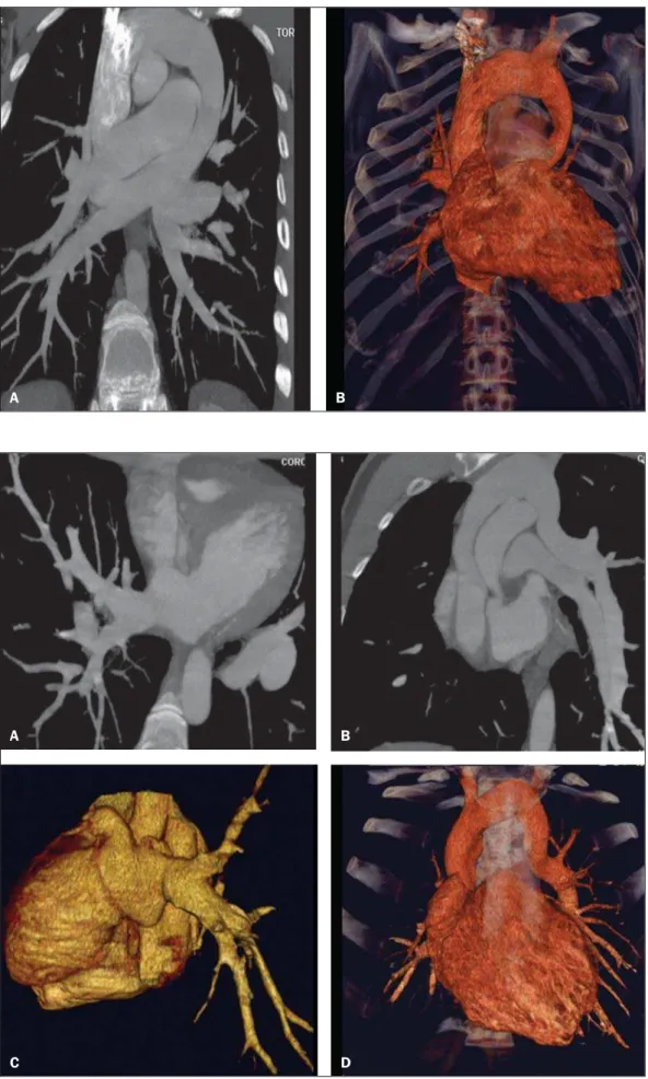 Figure 2. Multiplanar (A) and three-dimensional (3D) (B)  re-construction of MCTA in a male, 35-year-old patient  sub-mitted to examination because of suspicion of a mediastinal tumor, demonstrating a total anomalous pulmonary venous connection represented