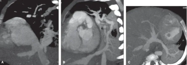 Figure 4. Multiplanar reconstruction of MCTA in a female, 6-month-old patient with partial anomalous pulmonary venous drainage, demonstrating that the right inferior pulmonary vein drains into the inferior vena cava (A) and the left inferior pulmonary vein