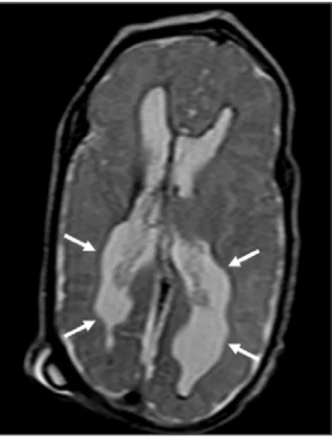 Figure 5. Axial T2WI (5610/159) image demon- demon-strates ventricular deformities evidenced as irregular ventricular walls (arrows).