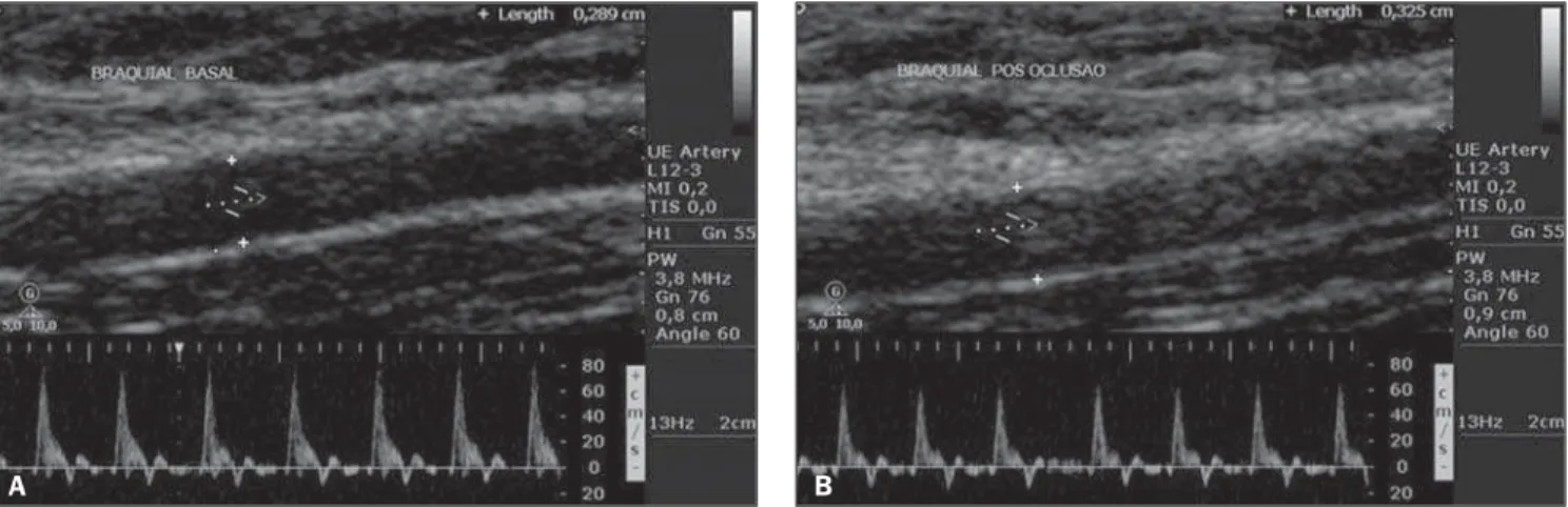 Figure 1. Longitudinal echographic image of brachial artery of a patient with no risk for atherosclerosis, with measurement of the initial diameter of the bra- bra-chial artery (pre-occlusion) corresponding to 0.8 cm and final to 0.9 mm, with BAFMD value c