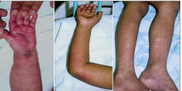 Figure 1. Hemorrhagic manifestations of mild and severe DHF.