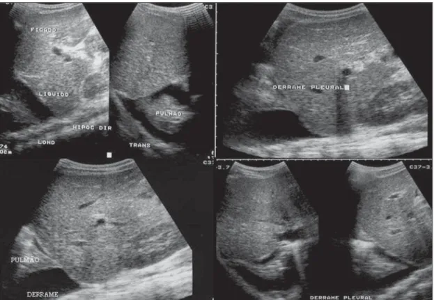 Figure 2. Pleural effu- effu-sion at right, usual  find-ing of plasma leakage, present even in a subtle presentation in children with classical dengue