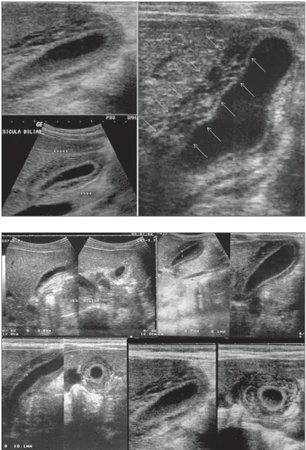 Figure 6. Longitudinal section of gallbladder, demonstrating a striated pattern of parietal thickening with multiple  echo-genic layers intermingled with fluid.