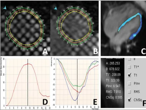 Figure 1. ECG-gated cine-MRI acquisition in four chamber (A,B) and delayed enhancement in four chamber (C) and short axis (D).
