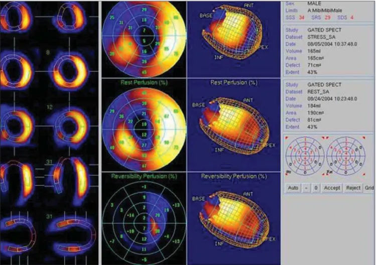 Figure 3. Graphic representation of functional gated SPECT images. From left to right: images of the heart at end-systole and diastole to evaluate systolic thickening; polar perfusion maps for analysis of perfusion reversibility, three-dimensional represen
