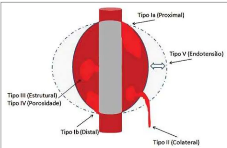 Figure 2. Sample percentage distribution chart as regards endoleak types classification.