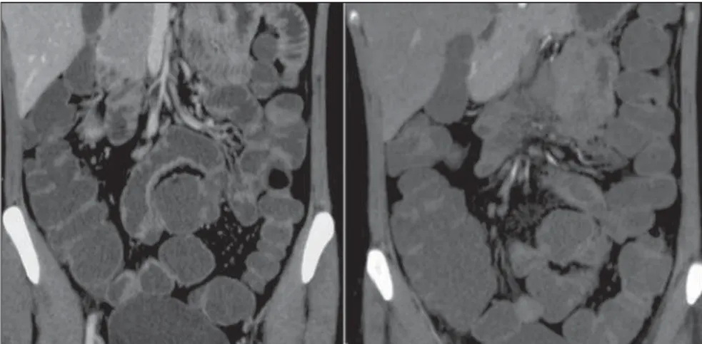 Figure 1. CT enterography, coronal section of a 30-year-old female patient. The study was performed after oral ingestion of non-absorbable neutral contrast medium (polyethylene glycol), demonstrating good distension of different intestinal segments, from t