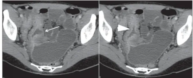 Figure 3. CT enterography image in the axial plane, of 18-year-old patient with diarrhea and abdominal pain of undefined etiology.