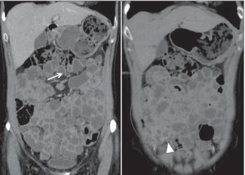 Figure 5. Female, 46-year-old patient, diagnosed with celiac disease. CT enterography demonstrates reversed pattern of the jejunoileal folds with loss of conniving valves and villous atrophy of the jejunum (arrow) associated to ileal jejunization represent