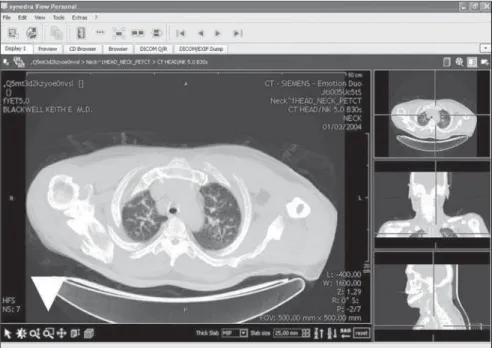 Figure 4. Synedra View Personal software screen. The multiplanar reconstruction function is being used, showing the three orthogonal planes