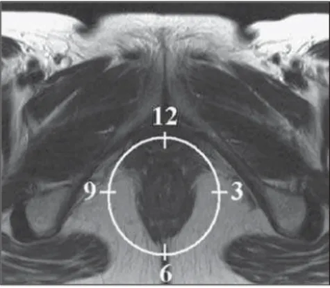 Figure 1. Representation of a clock face projected over the anal region on a MRI view in the axial plane.
