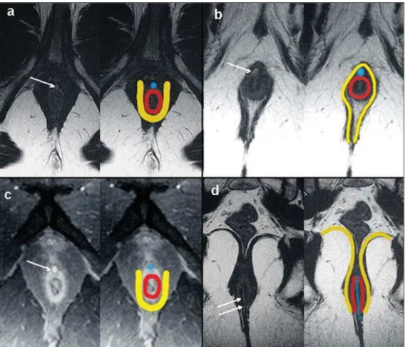 Figure 2. Simple linear intersphinc- intersphinc-teric fistula (type 1). T1-weighted (a) and T1-weighted sequences with fat suppression after gadolinium  injec-tion in the axial plane (c) and  T2-weighted in the axial plane (b) and in the coronal plane (d)