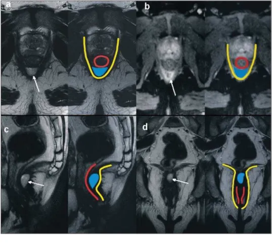 Figure 3. Intersphincteric fistula with ab- ab-scess or secondary tract (type 2).  T2-weighted sequences in the axial plane (a), sagittal plane (c) and coronal plane (d) and T1-weighted sequence in the axial plane with fat suppression after gadolinium  inj