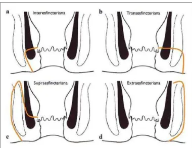 Figure 7. Schematic drawing of the types of fistula in ano: internal sphincter (black); external sphincter (white); fistulous tracts (orange).