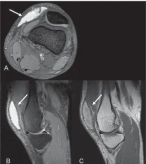 Figure 1. Morel-Lavallée lesion. MRI, axial T2-weighted sequence with fat sat (A) and sagittal T2-weighted sequences with fat sat (B) and T1-weighted  se-quence (C) demonstrating an  encapsu-lated, fusiform, expansile lesion in the prepatellar region betwe