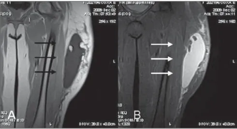 Figure 2. Morel-Lavallée lesion located in its most common site, in a patient with increase of soft tissues on the lateral aspect of the thigh developed after a car accident
