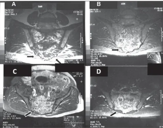 Figure 4. A,B: Coronal MRI sections demonstrating extensive sacral bone marrow replacement, including  pos-terior elements with heterogeneous signal intensity on T1- (A) and  T2-weighted (B) sequences in  associa-tion with appearance of bone  insuf-flation