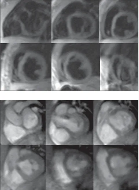 Figure 2. ECG-gated cine-MRI acquisition in short axis covering the whole extent of the left ventricle from the base to the left ventricular apex during diastole.