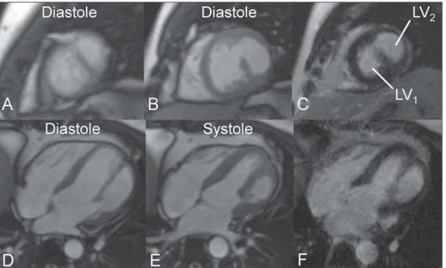 Figure 1. ECG-gated MRI morphology, black-blood, T1-weighted sequence with fat suppression in short axis view,  cover-ing the whole extent of the left ventricle from the base to the left ventricular apex at mid-diastole